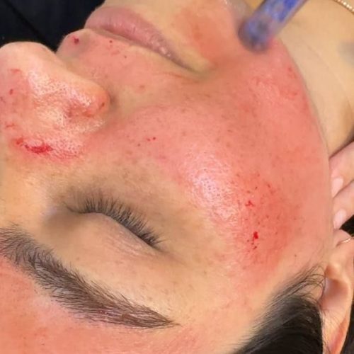 مزونیدلینگ و خالبرداری