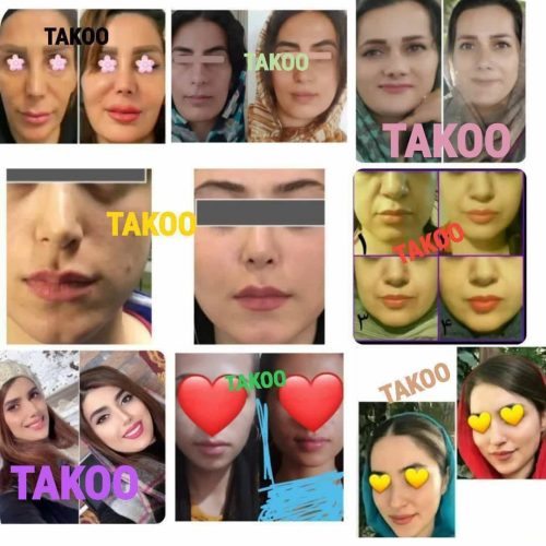 اگه میخوای پوستی صاف بدون لک جوش وبدون چروک وشاداب داشته باشی بهم پیام بده تا با مشاوره رایگان راهنمایت بکنم