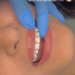 تزریق بوتاک