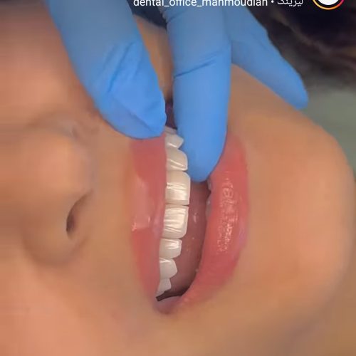 تزریق بوتاک