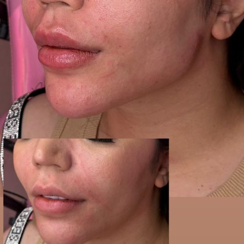 مدل برای تزریق ژل و بوتاکس