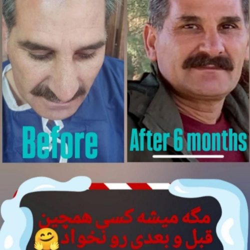 اولین مرکز کاشت مو در ملایر با مجوز رسمی