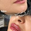 ترزیقات تخصصی لب و گونه و چونه