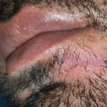 بخیه صورت و بدن (ترمیم پلاستیک بدون جای بخیه)