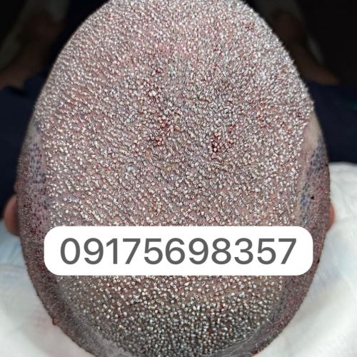 کاشت مو،ریش،کاشت ابرو