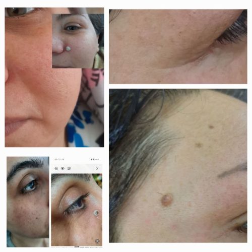 برداشتن خال زگیل و میخچه با محلول صدر صد گیاهی