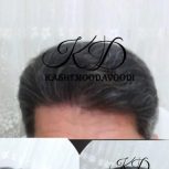 اولین مرکز کاشت مو در ملایر با مجوز رسمی