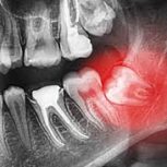 جراحی دندان عقل