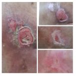 درمان تخصصی انواع زخم ها توسط پزشک عمومی مجرب