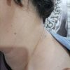 برداشتن خال زگیل و میخچه با محلول صدر صد گیاهی
