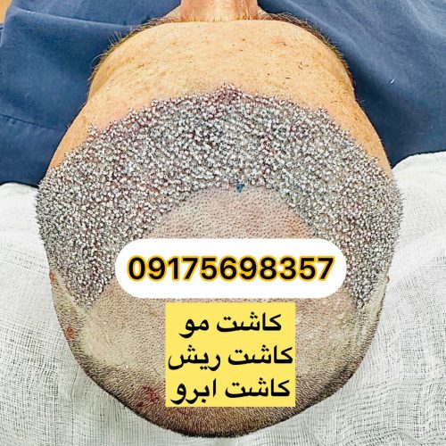 کاشت مو،ریش،کاشت ابرو