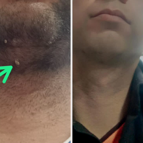 برداشتن خال زگیل و میخچه با محلول صدر صد گیاهی