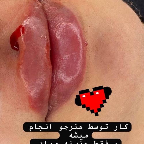 مدل ژل لب.گونه.چانه.زاویه و بوتاکس