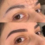 میکروبلیدینگ فیبروز شیدینگ لب بنمژه رایگان