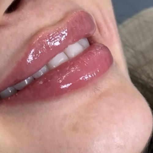 تزریق فیلر لب