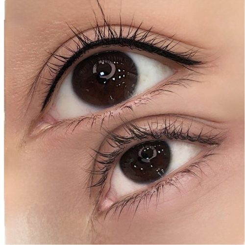 میکروبلیدینگ فیبروز شیدینگ لب بنمژه رایگان