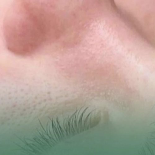 پاکسازی وفیشال پوست