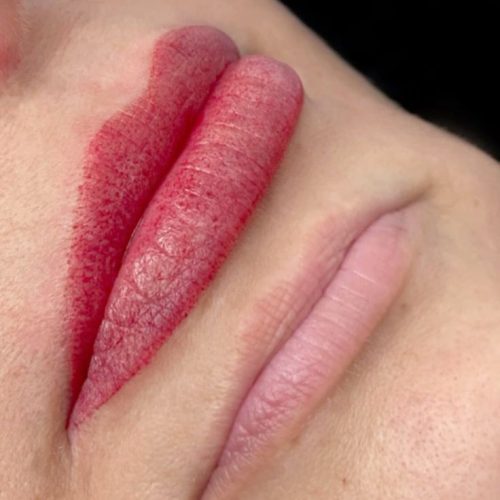 میکروبلیدینگ فیبروز شیدینگ لب بنمژه رایگان