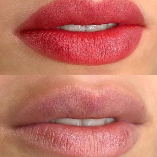 میکروبلیدینگ فیبروز شیدینگ لب بنمژه رایگان