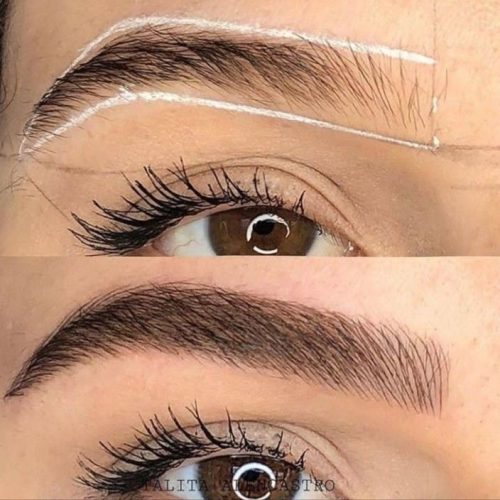 میکروبلیدینگ فیبروز شیدینگ لب بنمژه رایگان