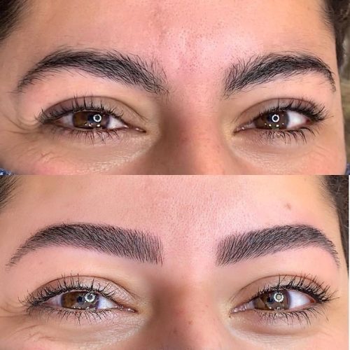 میکروبلیدینگ فیبروز شیدینگ لب بنمژه رایگان