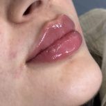 تزریق فیلر لب