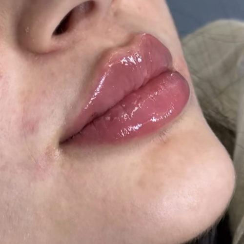 تزریق فیلر لب