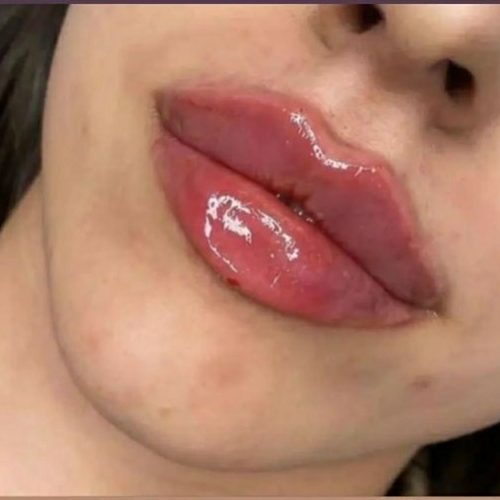 آف ژل بوتاکس ناخن