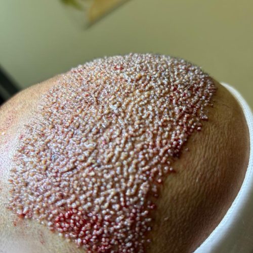 کاشت مو در یک جلسه