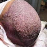 کاشت مو در یک جلسه