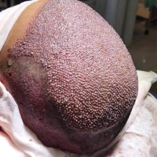 کاشت مو در یک جلسه