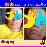 موثرترین درمان برای لک صورت