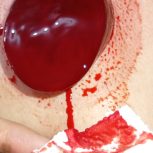 تزریقات و حجامت درمنزل شما