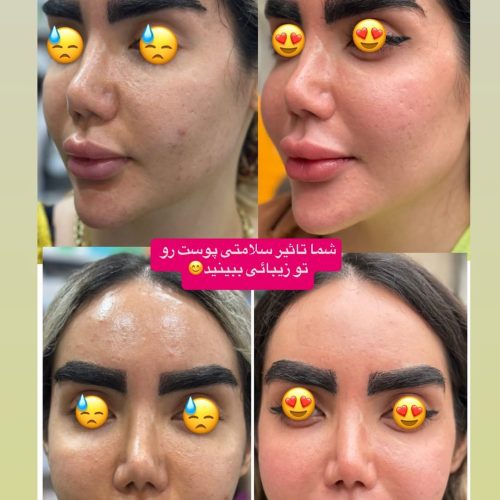 فیشال ،میکروندلینگ، پلاژن تراپی