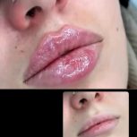 ژل و بوتاکس