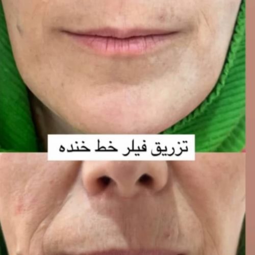 ژل و بوتاکس