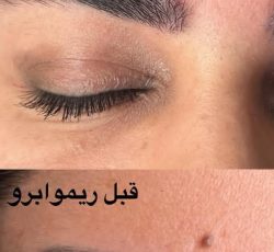 انجام ریموو تک جلسه ای ، فیبروز، میکرو بلیدینگ ، خط چشم و بن مژه با بهترین مواد