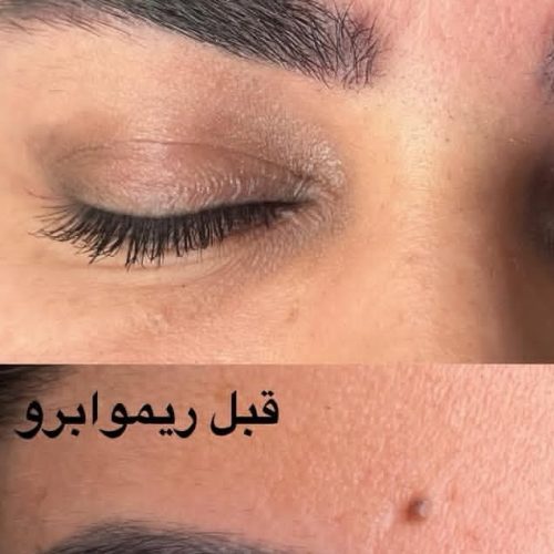 انجام ریموو تک جلسه ای ، فیبروز، میکرو بلیدینگ ، خط چشم و بن مژه با بهترین مواد