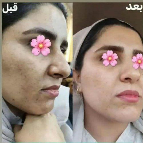 کرم ضد لک لاکچری کوین