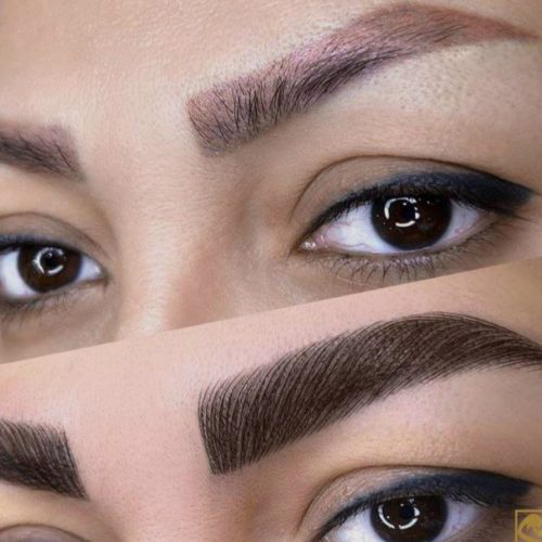 فیبروز وناخن و کراتین و برداشتن خال