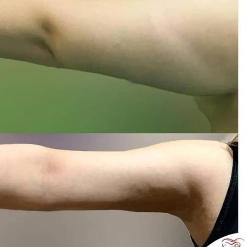 ساکشن ابدو بینی پروتز لیفت شقیقه اقساط تهران