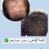 کچلی درمان شد