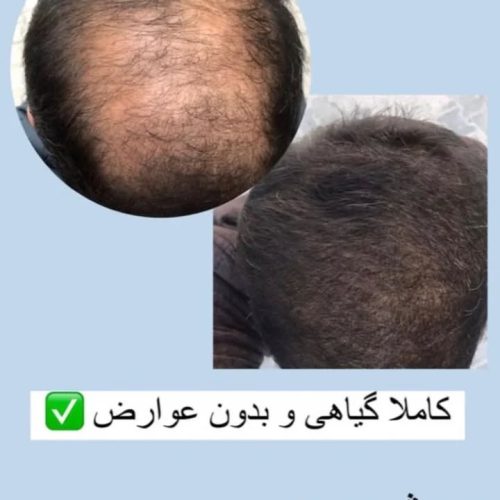 کچلی درمان شد