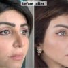 ساکشن ابدو بینی پروتز لیفت شقیقه اقساط تهران