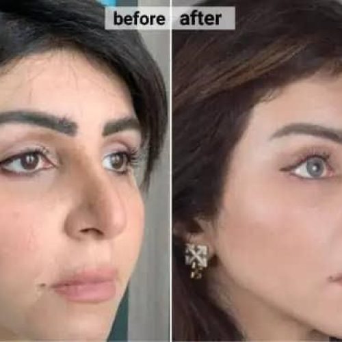 ساکشن ابدو بینی پروتز لیفت شقیقه اقساط تهران