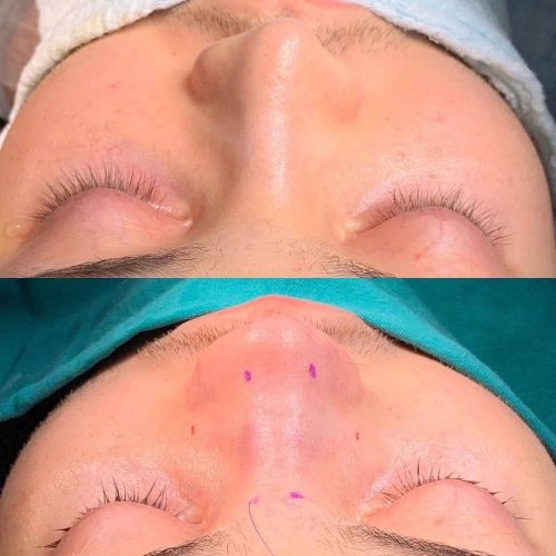 ساکشن ابدو بینی پروتز لیفت شقیقه اقساط تهران