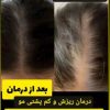 کچلی درمان شد