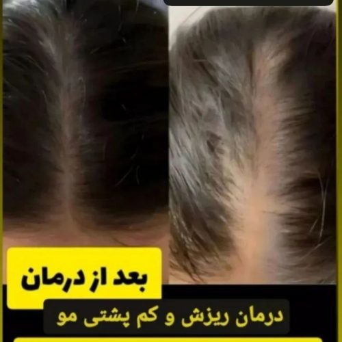 کچلی درمان شد