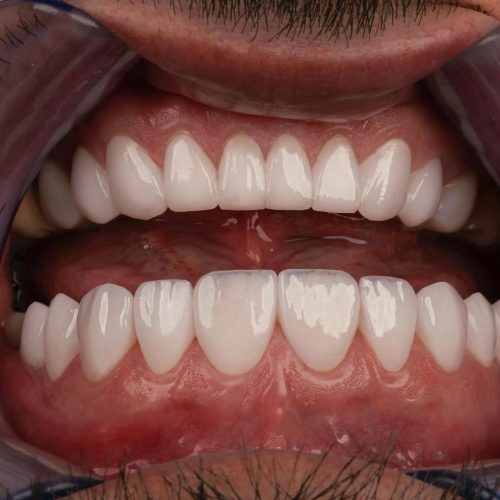 🎉جشنواره ایمپلنت دندان🎉