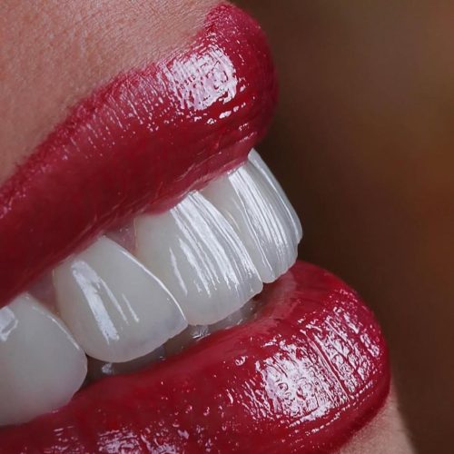 🎉جشنواره ایمپلنت دندان🎉